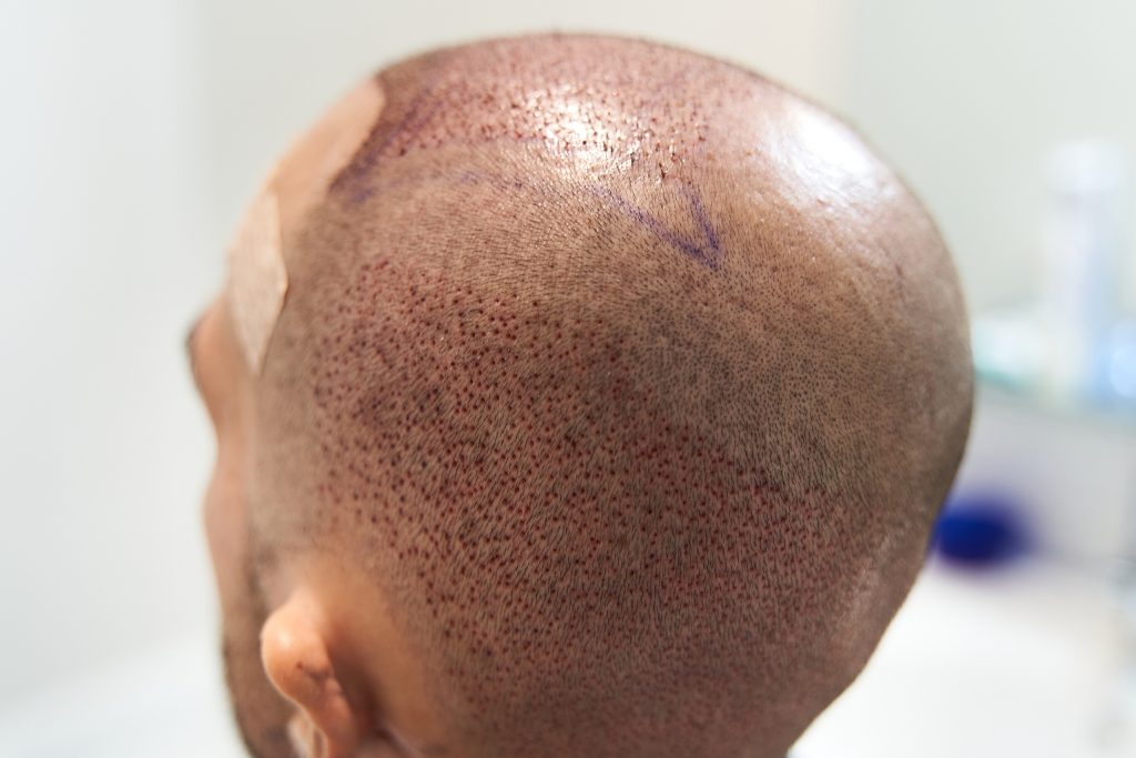 how much is a hair transplant in turkey